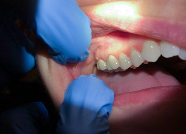 Best Emergency Broken Tooth Repair in Hammond, IN